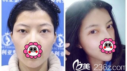 襄陽(yáng)維多利亞雙眼皮案例