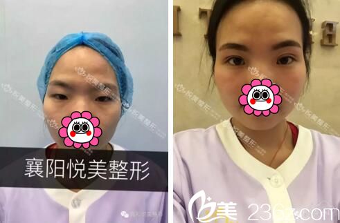 襄陽(yáng)悅美雙眼皮案例