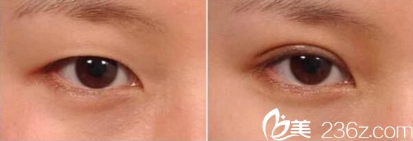 襄陽(yáng)伊萊美雙眼皮案例
