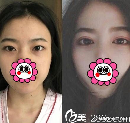 襄陽(yáng)韓蔻雙眼皮真人案例