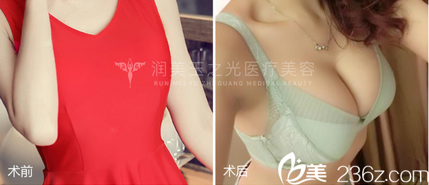 北京潤美玉之光王明利醫(yī)生自體脂肪豐胸