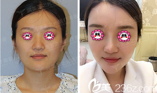 北京潤美玉之光王明利醫(yī)生面部脂肪填充