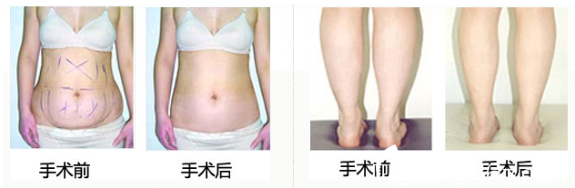 無錫坤如瑪麗吸脂案例 無錫坤如瑪麗吸脂案例