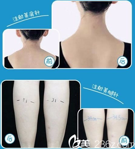 智海玲注射瘦肩和瘦腿案例 智海玲注射瘦肩和瘦腿案例