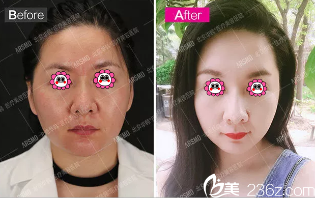 藍(lán)紹梓6D鉆石線雕提拉逆齡術(shù)經(jīng)典案例