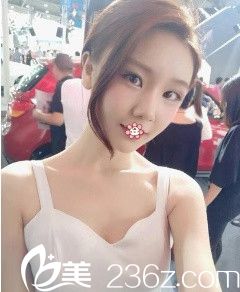 <!--<i data=20240703-sp></i>-->美萊楊繼紅自體脂肪填充術(shù)后一個(gè)月