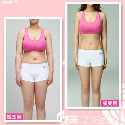 廣<!--<i data=20240703-sp></i>-->寧東方整形醫(yī)院<!--<i data=20240703-sp></i>-->做的吸脂案例