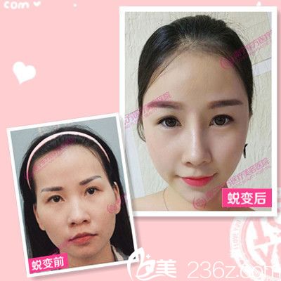 廣<!--<i data=20240703-sp></i>-->寧東方整形醫(yī)院劉剛做的隆鼻案例