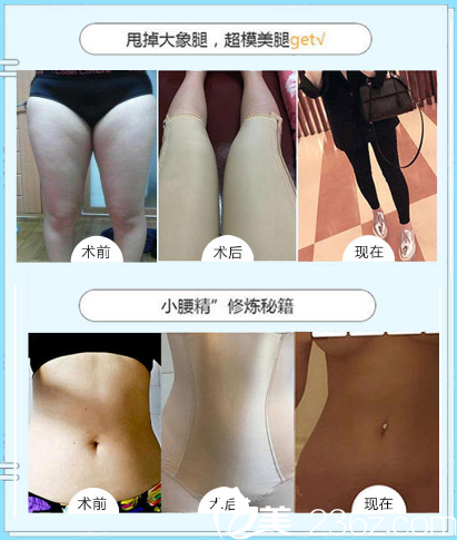 南寧夢(mèng)想陳建軍做的大腿吸脂和腰腹部抽脂案例