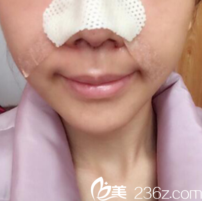 鼻綜合術后第2天照片