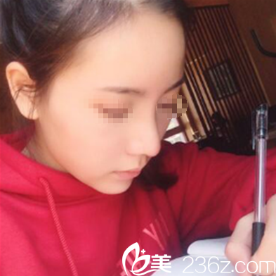 四川廣元醫(yī)爾美美華綜合隆鼻術后效果