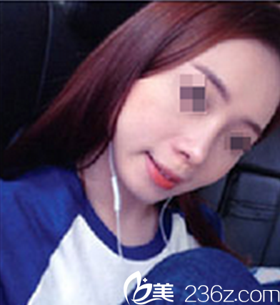 考慮再三，我選擇了在四川廣元醫(yī)爾美華美找董甫生做鼻綜合，看我隆鼻后得美照