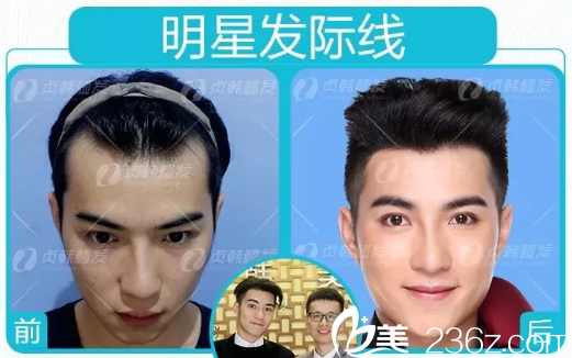 南寧貞韓植發(fā)醫(yī)院明星發(fā)際線種植效果圖