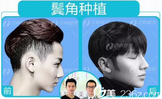 南寧貞韓植發(fā)醫(yī)院做鬢角種植效果圖