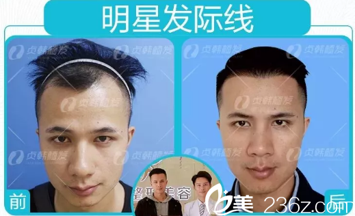 林先生在南寧貞韓植發(fā)醫(yī)院做發(fā)際線種植的親身經(jīng)歷