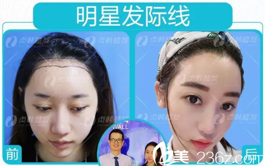 季女士在南寧貞韓植發(fā)醫(yī)院做發(fā)際線種植的術(shù)后效果