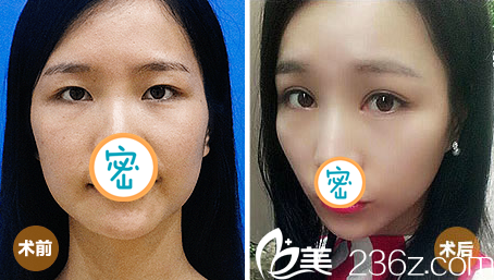廣元醫(yī)而美美華整形外科雙眼皮案例效果