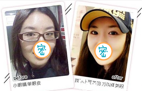 廣元美華雙眼皮案例對(duì)比照片