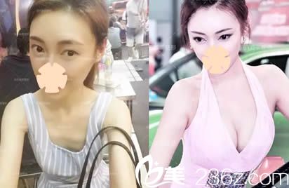 楚雄吳氏嘉美整形美容門(mén)診假體隆胸案例效果圖 楚雄吳氏嘉美整形美容門(mén)診假體隆胸案例效果圖