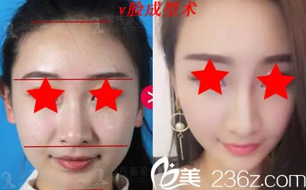 楚雄吳氏嘉美整形美容醫(yī)院面部輪廓效果對(duì)比圖 楚雄吳氏嘉美整形美容醫(yī)院面部輪廓效果對(duì)比圖