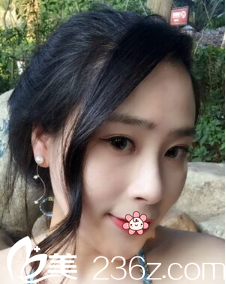 貴州利美康劉德東假體墊下巴術(shù)后一個(gè)月 貴州利美康劉德東假體墊下巴術(shù)后一個(gè)月