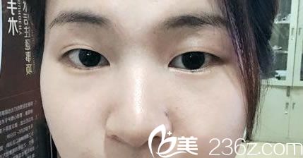 在金華玥萊美做雙眼皮之前 在金華玥萊美做雙眼皮之前