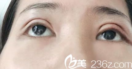 做完雙眼皮手術(shù)的照片 做完雙眼皮手術(shù)的照片