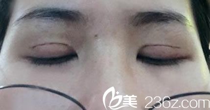 7天拆完線疤痕恢復(fù)情況 7天拆完線疤痕恢復(fù)情況