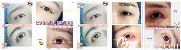 昆明璀璨人生眼綜合真人案例1