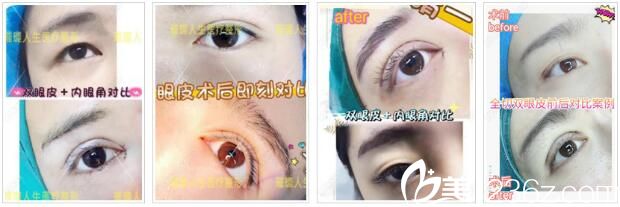 昆明璀璨人生眼綜合真人案例2