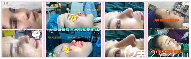 昆明璀璨人生鼻綜合真人案例1