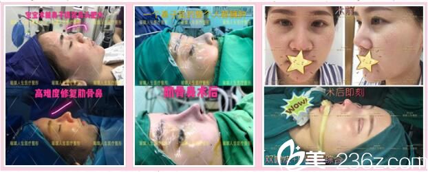 昆明璀璨人生鼻綜合真人案例2