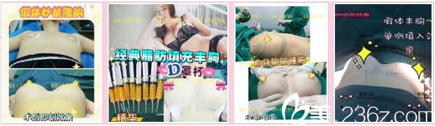 昆明璀璨人生胸部整形真人案例1