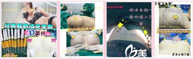 昆明璀璨人生胸部整形真人案例2