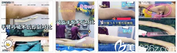 昆明璀璨人生抽脂填充真人案例1