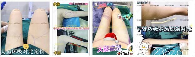 昆明璀璨人生抽脂填充真人案例2