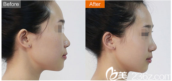 李冬醫(yī)生喬雅登隆鼻豐額頭案例 李冬醫(yī)生喬雅登隆鼻豐額頭案例