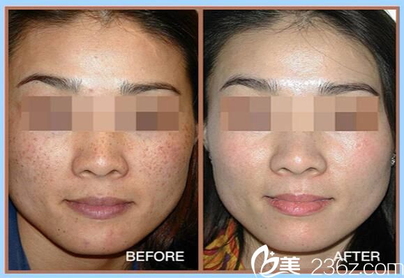 郄美芳激光祛斑案例 郄美芳激光祛斑案例