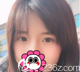 豆豆眼的我在煙臺(tái)美神醫(yī)療美容醫(yī)院做了全切雙眼皮，并且要了份眼部整形價(jià)格表  