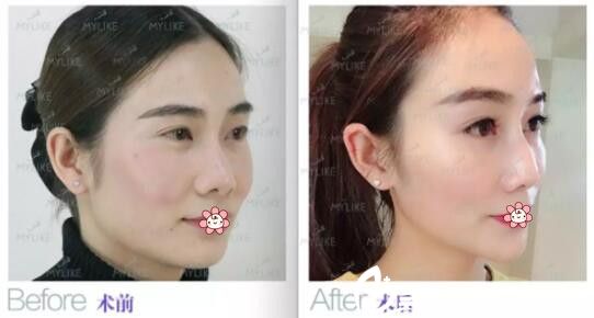 蒲翠玲玻尿酸注射案例 蒲翠玲玻尿酸注射案例