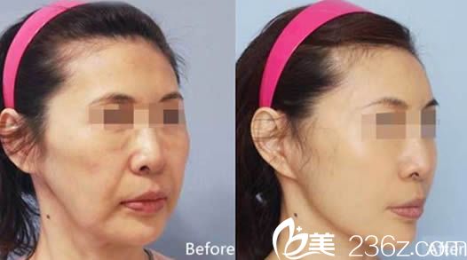 楚雄吳氏嘉美整形美容醫(yī)院劉勤主任青春鎖除皺術(shù)效果圖