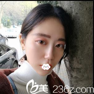 隨州假體隆鼻整形哪家好？我到隨州奧萊院長處做鼻綜合隆鼻手術(shù)3個月