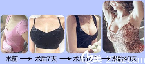 提曉華院長自體脂肪豐胸案例