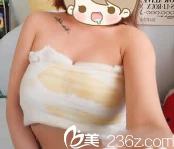 我在聊城韓美整形做假體隆胸術(shù)后第3天照片