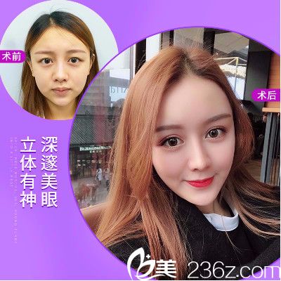 深圳美萊周洪超醫(yī)生做的雙眼皮案例