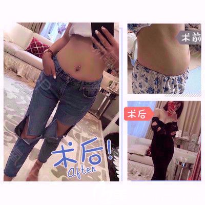 深圳美萊周洪超醫(yī)生做的腰腹部吸脂案例