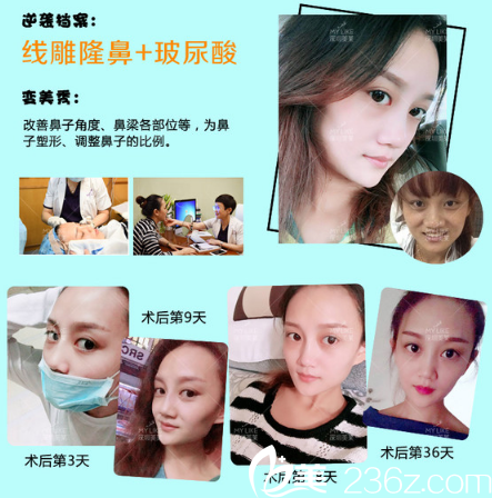 深圳美萊黃海龍做的線雕隆鼻和玻尿酸填充案例 深圳美萊黃海龍做的線雕隆鼻和玻尿酸填充案例