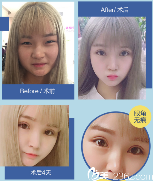 廣州美萊曾德淵醫(yī)生做的雙眼皮開眼角案例 廣州美萊曾德淵醫(yī)生做的雙眼皮開眼角案例