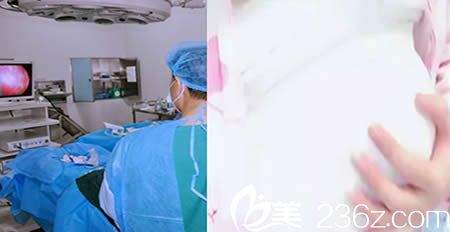 楚雄吳氏嘉美整形醫(yī)院內(nèi)窺鏡假體隆胸術(shù)中圖