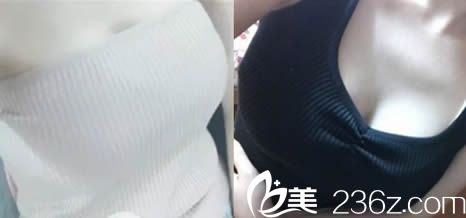 楚雄吳氏嘉美曼托假體隆胸術(shù)后15天照